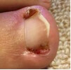 爪のトラブル 陥入爪