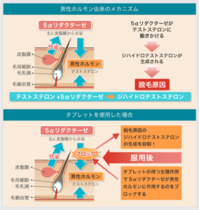 男性の薄毛治療 薄毛の原因