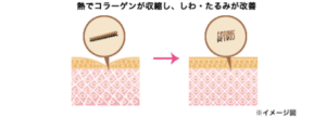 顔のたるみ　治療経過