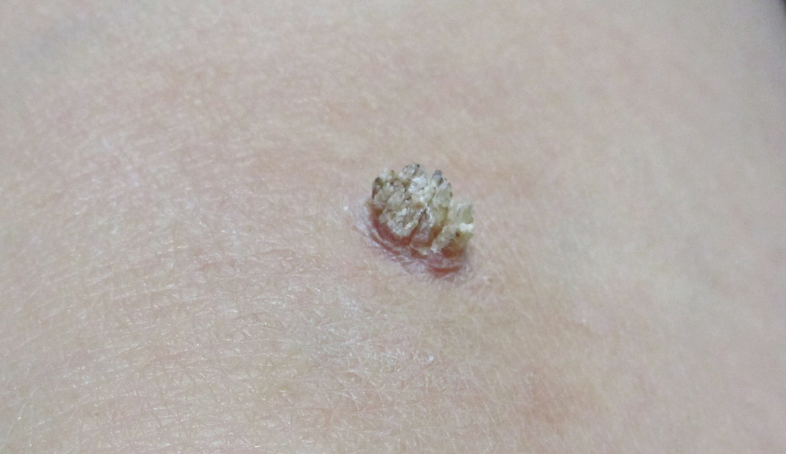皮膚腫瘍　尋常性疣贅（イボ）