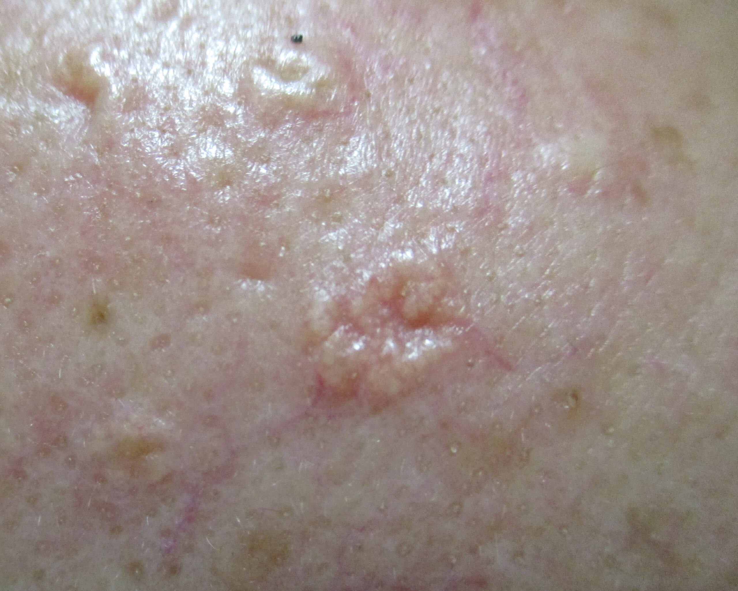 皮膚腫瘍　脂腺増殖症