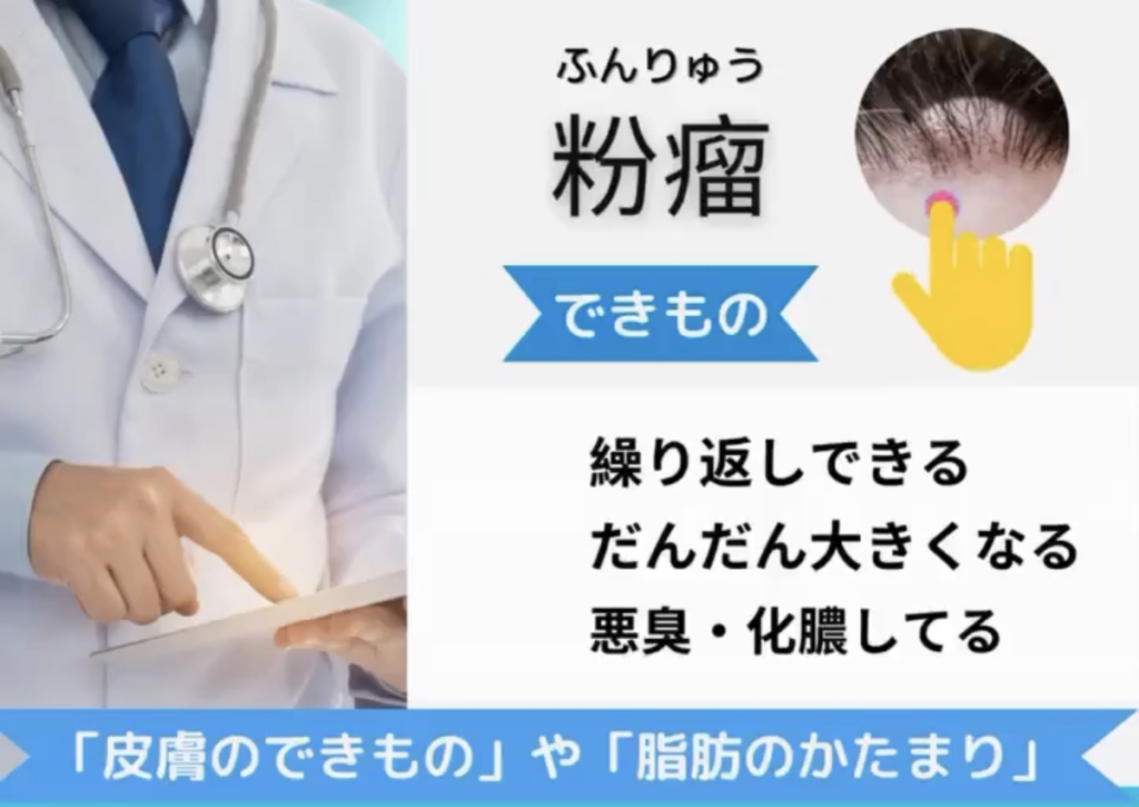 粉瘤　繰り返しできる出来もの除去治療
