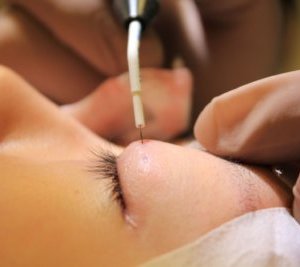 二重整形 での高周波ラジオ針による穴開け