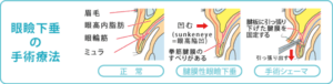 眼瞼下垂 手術