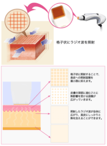 顔のたるみ　治療効果