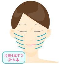 スレットリフト　イメージ